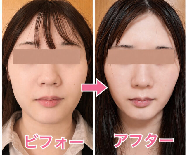 福井市　Nさん　20代女性